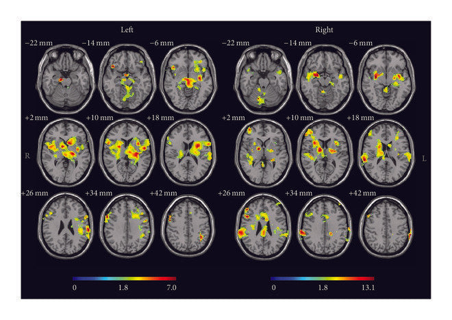 RESÚMEN DEL ARTÍCULO: "Investigating Acupuncture Using Brain Imaging Techniques: The Current State of Play"
